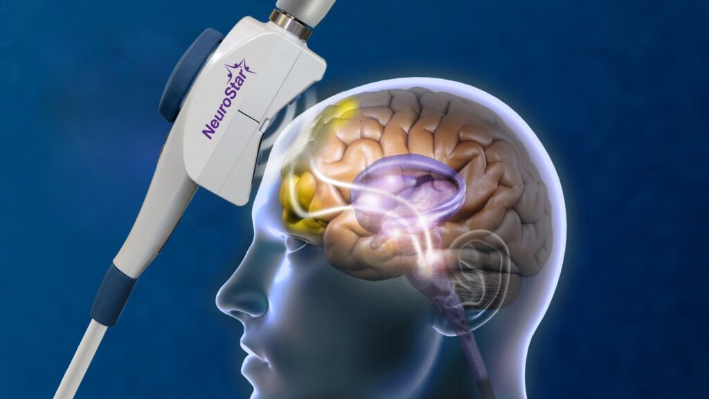 An image depicting a magnetic stimulation device positioned near a human brain model, suggesting the use of transcranial magnetic stimulation (TMS) to treat depression.