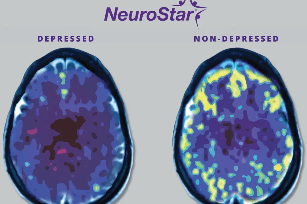 A visual comparison of brain patterns between people with and without depression, suggesting the physiological basis for exploring TMS as a treatment.