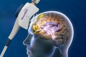 Can TMS cause memory loss is visualised as a TMS coil device targets the prefrontal cortex in a 3D brain cross-section.