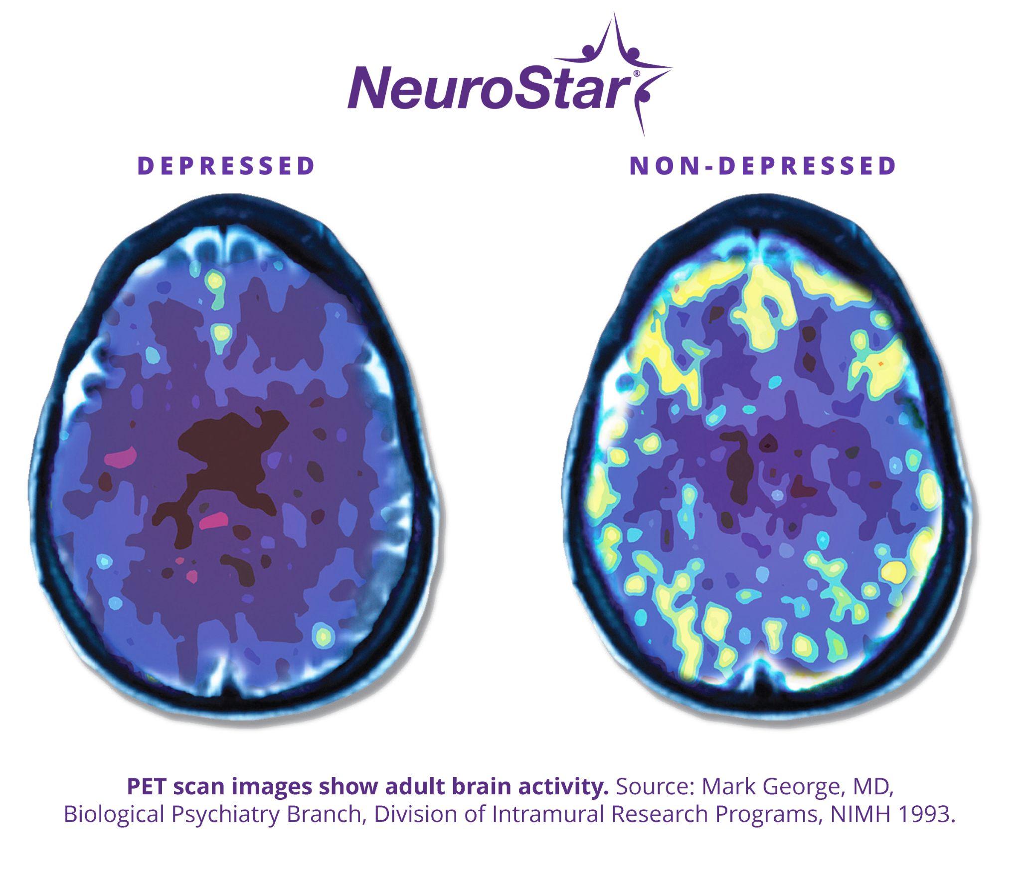 NeuroStar PET scan comparing brain activity levels between depressed and non-depressed adult brains.